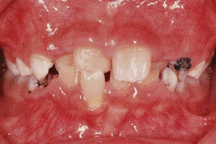 咬合性外傷により下顎右側中切歯の歯肉退縮、下顎左側側切歯の切端の破折