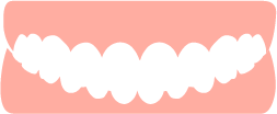 受け口（下顎前突）のイメージ